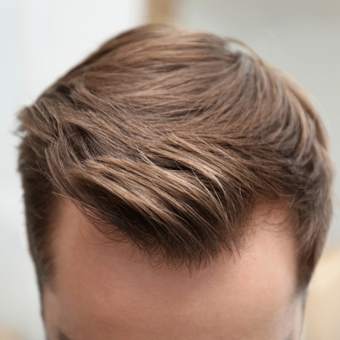 Greffe de Cheveux - Forfait FUE par lame Metal